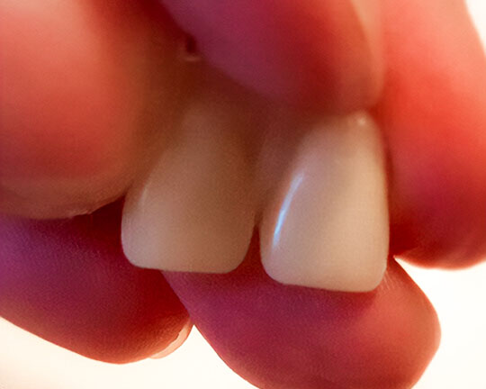 Denticor-fotó: két előre kialakított pótfog, elölről nézve.