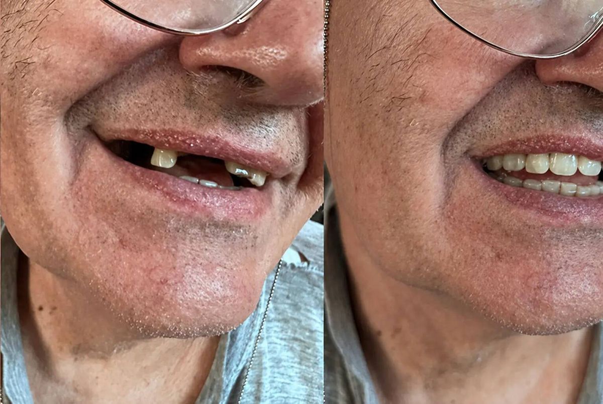 A réstől a mosolyig, behelyezett fogpótlással