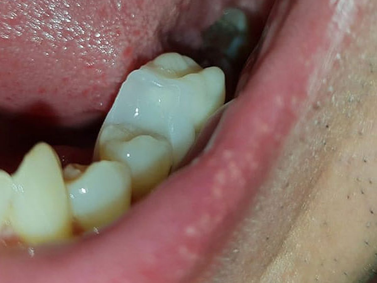 Az előkészített Denticor fogpótlás behelyezése a hiányzó hátsó fog helyére