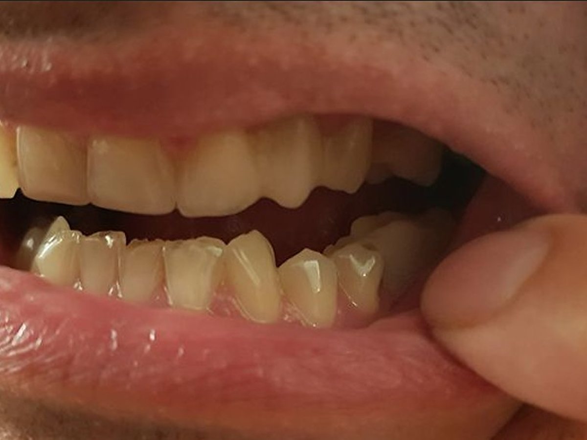 A Denticor pótlás a hiányzó hátsó fog helyére illesztve
