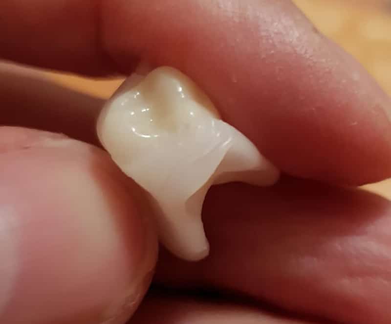 1 · A korona és a DentiFlex kapcsolata