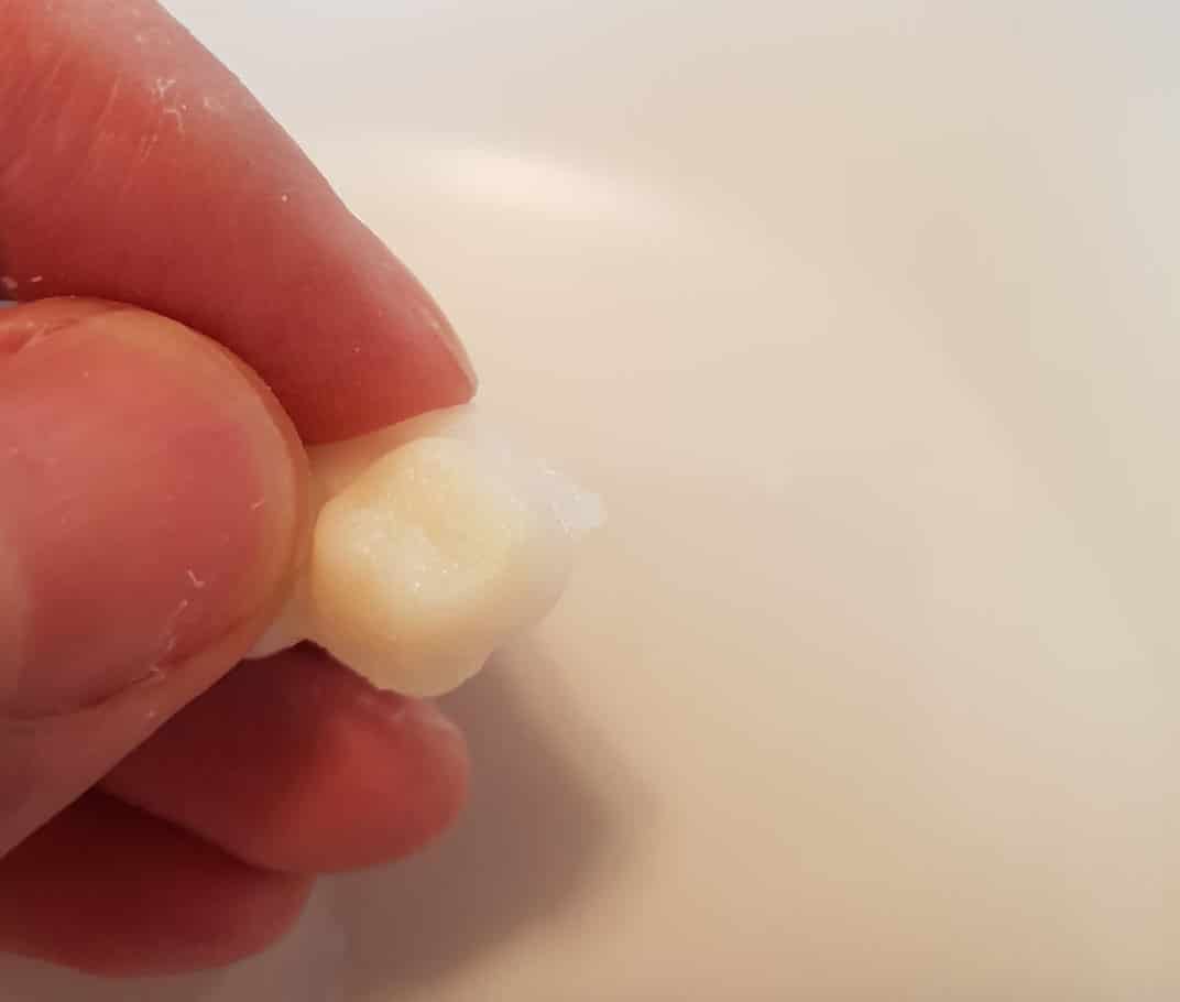 Az első Denticor fogpótlás-prototípus