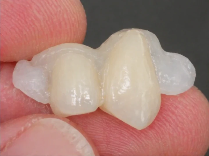 Kész Denticor pótlás fogkoronákkal egy testreszabható DentiFlex hídban