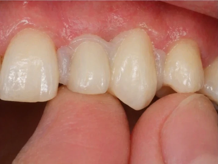 A Denticor pótlás behelyezése a szájban – alakzár a szomszédos fogak között