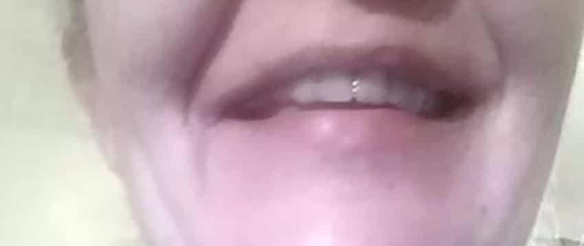 Ügyfelünk – Denticorral pótolt elülső fog