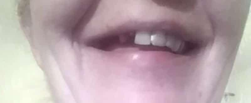 Ügyfél – eltört elülső fog, a Denticor felhelyezése előtt