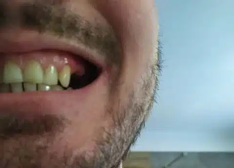Hiányzó oldalsó fog a Denticor használata előtt, oldalnézet
