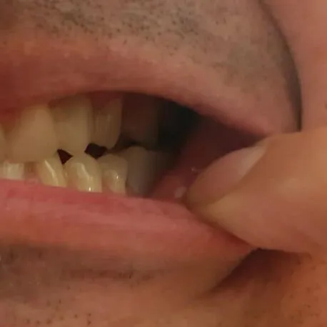 Ügyfél – az alsó fogat Denticorral pótolták