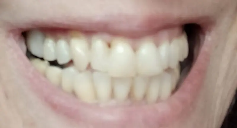 Vásárlónő – a rés Denticorral fedve