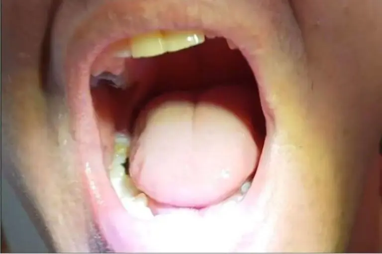 Ügyfél – Denticorral pótolt oldalsó fog