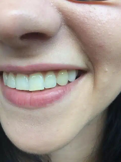 Mosoly az új, egyedi Denticor fog felhelyezése után