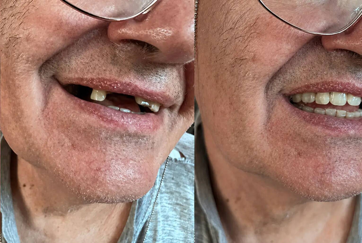 Ügyfél – több hiányzó fog a Denticor kezelés előtt és után